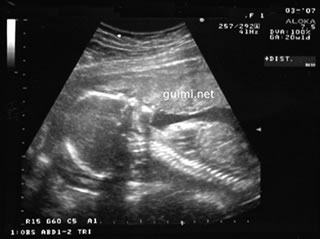 Ultraschall. Bild: Guimi/Wikimedia Commons 